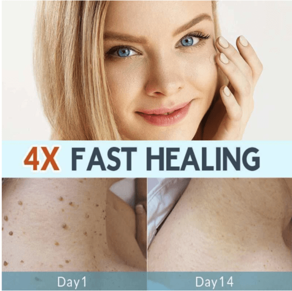 Skin Tag Removal Patches