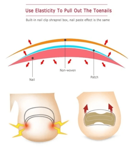 Painless Toenail Patch